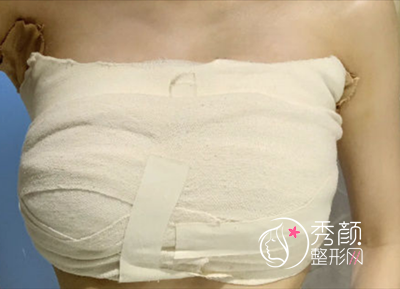 上海华美李健院长隆胸技术怎么样|案例曝光