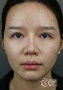 <b>首尔丽格朴兴植怎么样,颧骨内推朴兴植案例</b>
