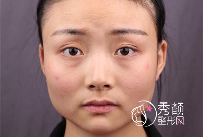国内具有磨骨资质的医生_李志海是不是较好的