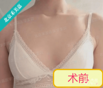 任学会脂肪隆胸多少钱|北京禾美嘉整形价格表