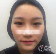 北京八大处滕利颧骨内推案例|价格