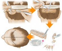 成都植发哪家医院好,一般需要多少钱?