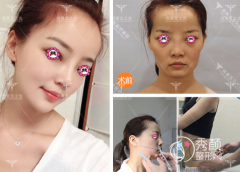 <b>王明利和邱立东脂肪填充谁做的比较好</b>