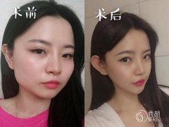 武汉华美和亚韩哪个磨骨好|案例对比|整体实力解析