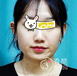 武汉亚韩赵贵庆磨骨怎么样|术前术后案例对比