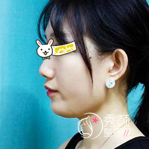 武汉亚韩赵贵庆磨骨怎么样|术前术后案例对比