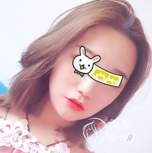 武汉亚韩赵贵庆磨骨怎么样|术前术后案例对比