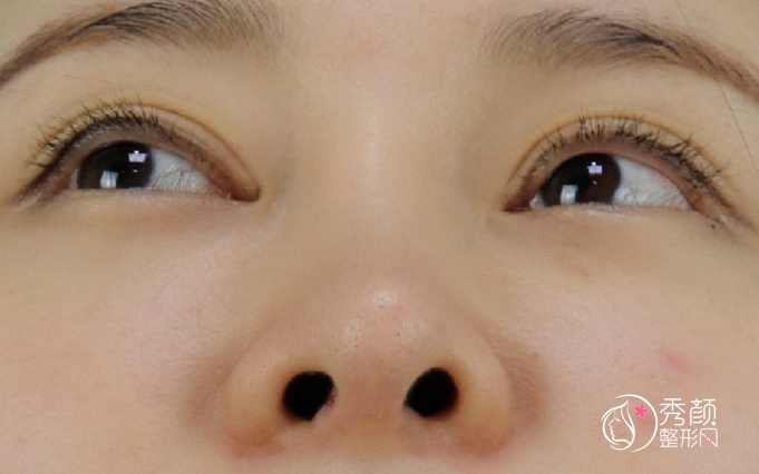 北京米扬丽格夏正义鼻修复怎么样|术后案例图对比一览