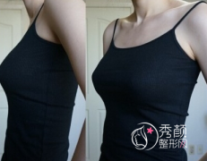 北京哪个医院隆胸好，大概需要多少钱