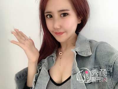 上海九院曹卫刚隆胸怎么样|术前术后案例对比