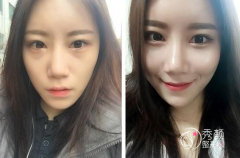 北京自体脂肪填充哪家医院好|价格表|医院整理