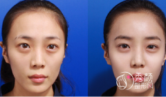 成都自体脂肪填充哪家医院好|价格表|医院整理