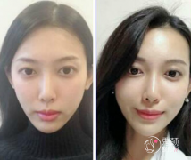 广州自体脂肪填充哪家医院好|多少钱|医院一览