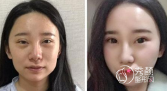 南京自体脂肪填充哪家医院好|多少钱|医院医生一览