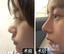 南京鼻修复哪个医生好|南京沈干鼻修复怎么样