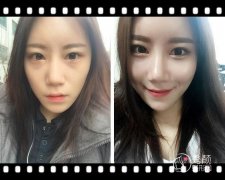 杭州自体脂肪填充哪家医院好|多少钱|医院医生一览