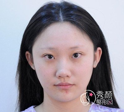 上海伊莱美李湘原磨骨|隆鼻怎么样|术前术后案例对比一览