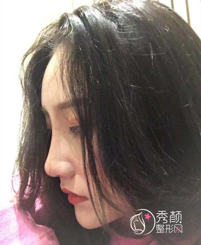 上海伊莱美李湘原磨骨|隆鼻怎么样|术前术后案例对比一览