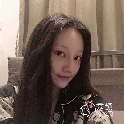 上海伊莱美李湘原磨骨|隆鼻怎么样|术前术后案例对比一览