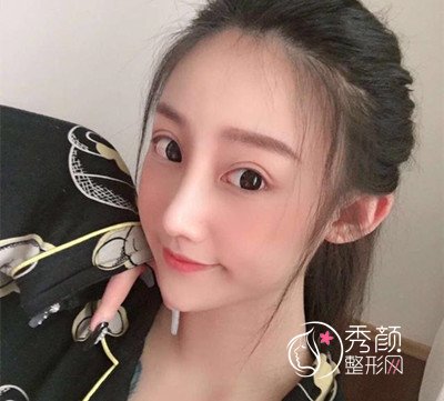 上海伊莱美李湘原磨骨|隆鼻怎么样|术前术后案例对比一览