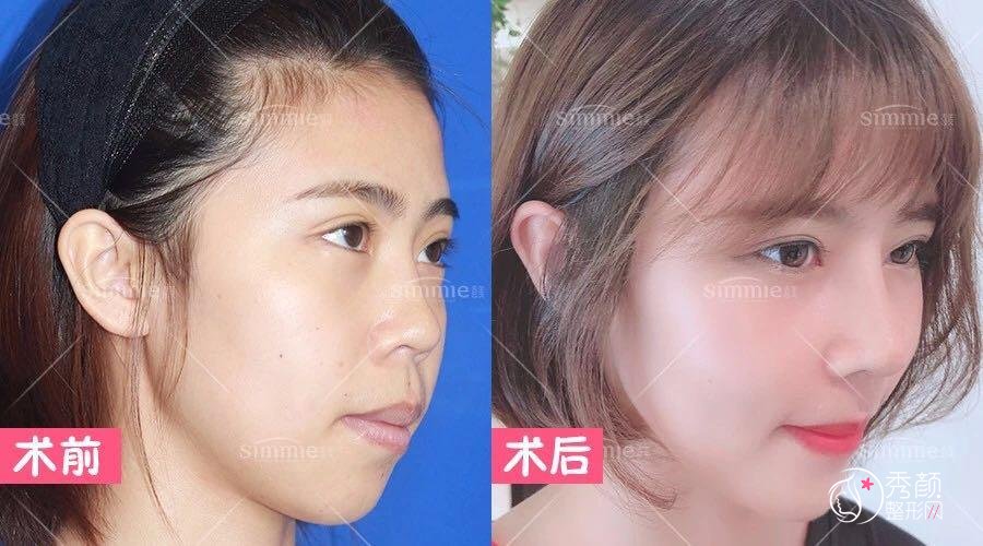 上海百达丽王艳和喜美王会勇哪个鼻子修复好|技术案例对比