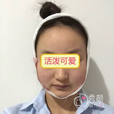 广州南方医院杜本军做下颌角怎么样|磨骨术前术后案例对比一览