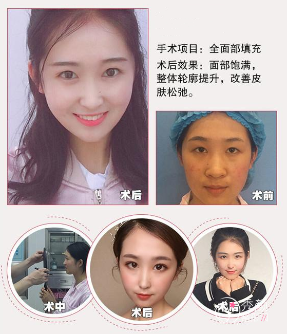 上海华美王荣锡主任自体脂肪填充怎么样|案例曝光
