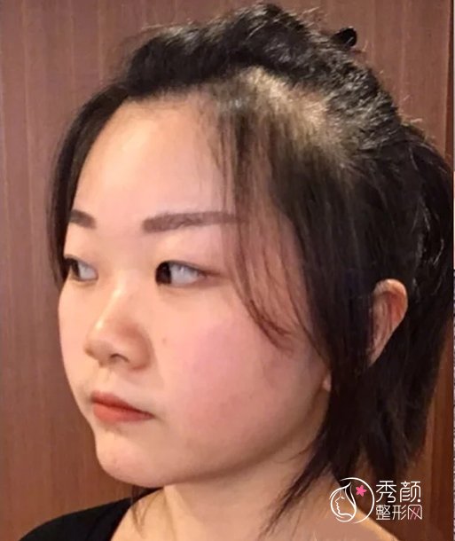 四川友谊医院李萍做鼻子怎么样|术前术后案例对比