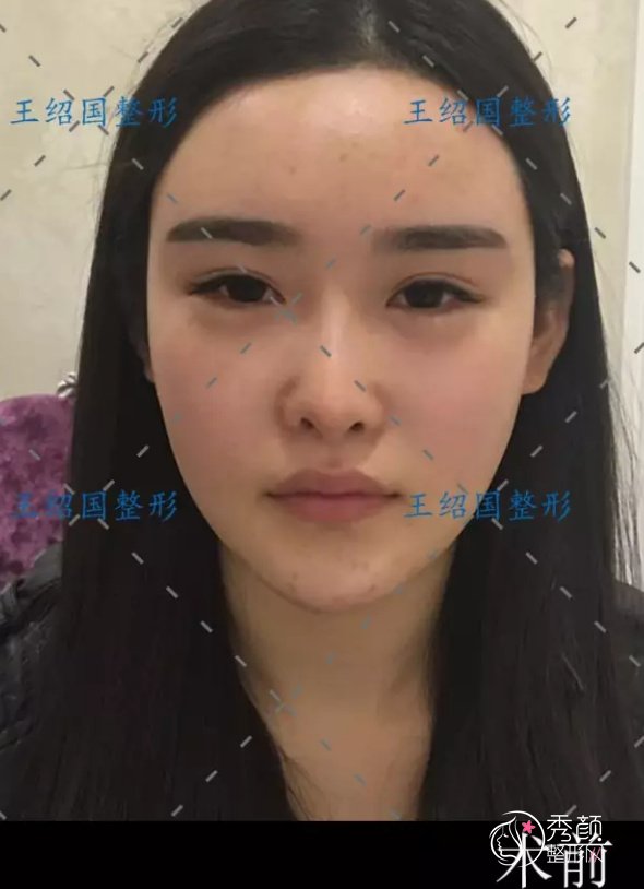 王绍国脂肪填充修复怎么样|价格表