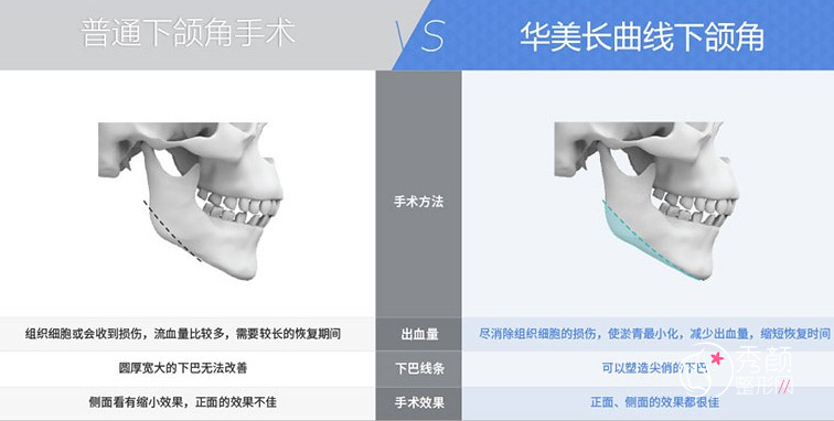 华美李志海磨骨怎么样|技术|口碑|预约