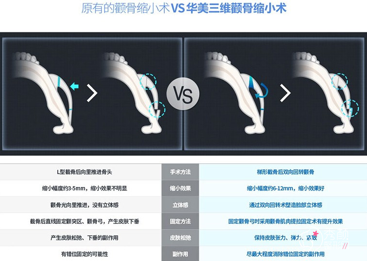 华美李志海磨骨怎么样|技术|口碑|预约