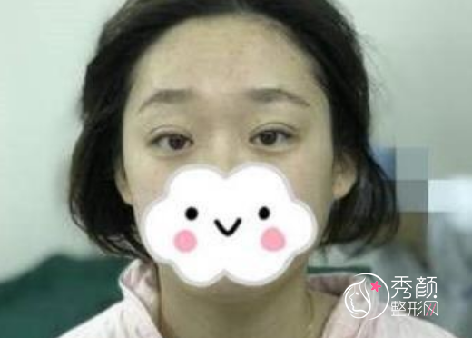 上海美莱杜园园双眼皮修复怎么样|案例图对比