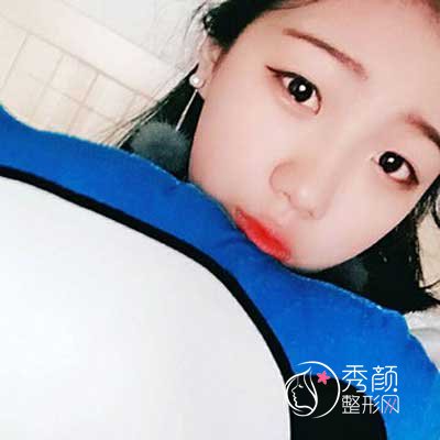 沈阳百嘉丽侯亚杰做双眼皮贵吗|术前术后案例对比