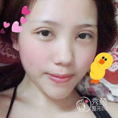 沈阳百嘉丽侯亚杰做双眼皮贵吗|术前术后案例对比