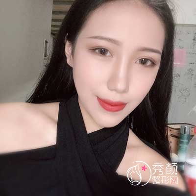沈阳百嘉丽侯亚杰做双眼皮贵吗|术前术后案例对比