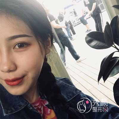 沈阳百嘉丽侯亚杰做双眼皮贵吗|术前术后案例对比