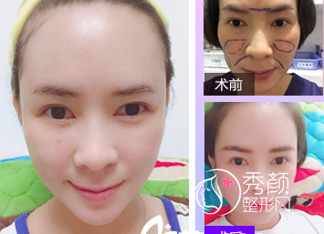 上海伊莱美李旭东自体脂肪填充怎么样|李旭东面部填充案例