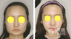 广州磨骨|下颌角|颧骨内推医生测评