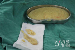 奥美定如何没问题取出|奥美定取出多少钱