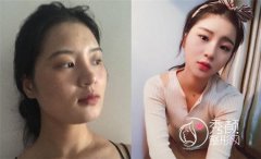<b>刘金超磨骨手术做得好吗</b>