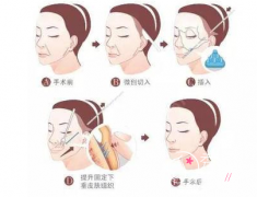 v美减龄和拉皮哪个好,有什么区别?