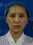 杭州华山连天美高俊明磨骨改脸型怎么样|案例曝光