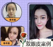 西安美莱哪个医生做双眼皮好|专家一览表