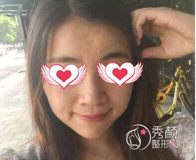 重庆华美华美李富强做脂肪填充怎么样|案例曝光