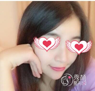 重庆华美华美李富强做脂肪填充怎么样|案例曝光