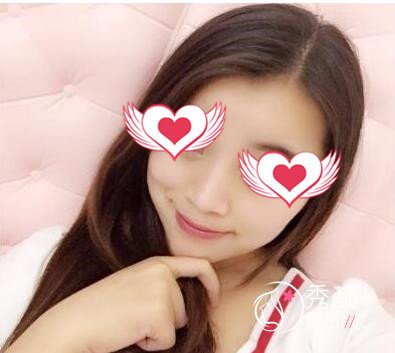 重庆华美华美李富强做脂肪填充怎么样|案例曝光