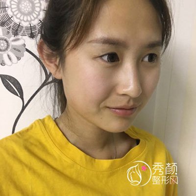 成都美莱黄小林做双眼皮怎么样|术前术后案例对比曝光