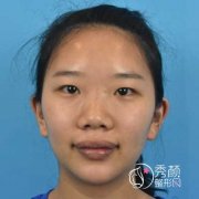 南京友谊上官文松做鼻子怎么样|案例曝光