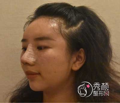 南京友谊上官文松做鼻子怎么样|案例曝光