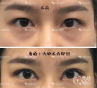 长沙爱思特张张姣姣和长沙亚韩郑京湘哪个做双眼皮技术更好?